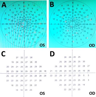 Case report and literature review: Resection of retroinfundibular craniopharyngioma via endoscopic far-lateral supracerebellar infratentorial approach